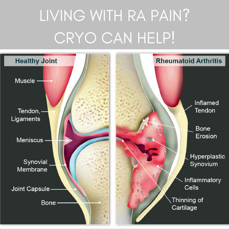 LIVING WITH RA PAIN CRYO CAN HELP